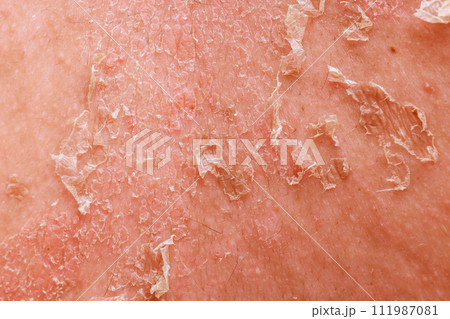 Psoriatic eczema is complex skin disease that demands multidisciplinary approach in dermatology. 111987081
