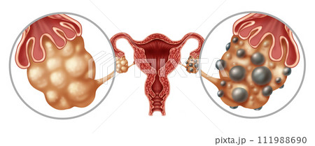 Polycystic Ovarian Syndrome 111988690