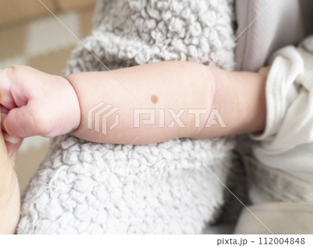 ほくろがある赤ちゃんの右腕 ほくろがある赤ちゃんの右腕 112004848