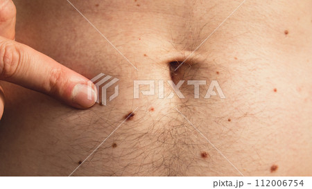 Male hand showing birthmarks on skin body stomach part. Close up detail of the bare skin. Health Effects of UV Radiation. Man with birthmarks Pigmentation 112006754
