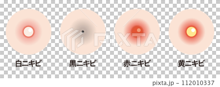 ニキビの種類 112010337