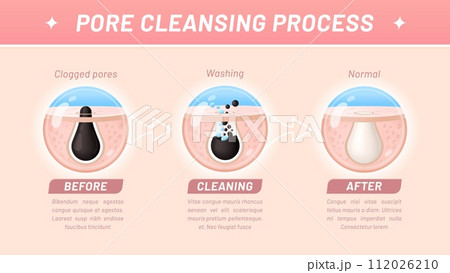 Skin cleaning, pore cleansing process. Vector step-by-step infographics involves removing debris, oil, and dead skin cells from clogged skin pores, exfoliation and washing, before and after visual aid Skin cleaning, pore cleansing process. Vector step-by-step infographics involves removing debris, oil, and dead skin cells from clogged skin pores, exfoliation and washing, before and after visual aid 112026210