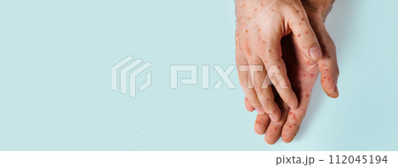 Human Hands with Painful Rash, Red Spots Blisters on the Skin. Health Problem. Monkeypox Disease Symptoms. Male Patient Arms with Monkey Pox. Close Up. Banner, Copy Space. Dengue Fever Infection, MPOX Human Hands with Painful Rash, Red Spots Blisters on the Skin. Health Problem. Monkeypox Disease Symptoms. Male Patient Arms with Monkey Pox. Close Up. Banner, Copy Space. Dengue Fever Infection, MPOX 112045194