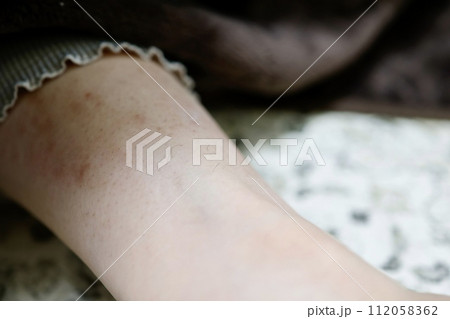 女性のすね毛の剃り残し及びカミソリ負けした皮膚 112058362