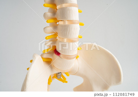 Lumbar spine displaced herniated disc fragment, spinal nerve and bone. Model for treatment medical in the orthopedic department. Lumbar spine displaced herniated disc fragment, spinal nerve and bone. Model for treatment medical in the orthopedic department. 112081749