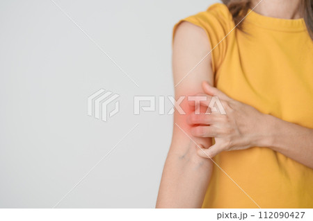 woman itching and scratching itchy arm. Sensitive Skin Allergic reaction to insect bite, food, drug dermatitis. Dermatology, Leprosy day, Systemic lupus erythematosus, Allergy symptoms and rash Eczema woman itching and scratching itchy arm. Sensitive Skin Allergic reaction to insect bite, food, drug dermatitis. Dermatology, Leprosy day, Systemic lupus erythematosus, Allergy symptoms and rash Eczema 112090427