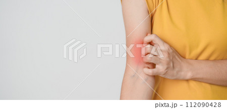 woman itching and scratching itchy arm. Sensitive Skin Allergic reaction to insect bite, food, drug dermatitis. Dermatology, Leprosy day, Systemic lupus erythematosus, Allergy symptoms and rash Eczema 112090428