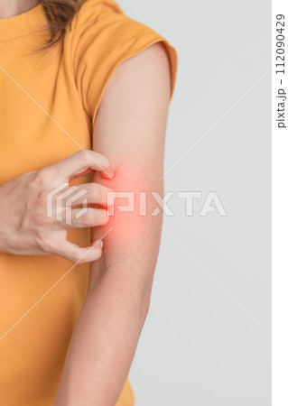 woman itching and scratching itchy arm. Sensitive Skin Allergic reaction to insect bite, food, drug dermatitis. Dermatology, Leprosy day, Systemic lupus erythematosus, Allergy symptoms and rash Eczema 112090429
