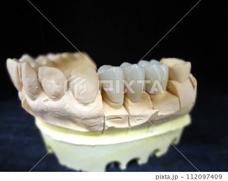 ハイブリッドレジン歯の模型・エステニア頬側面 112097409