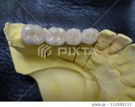 セラミック歯・歯科技工のメタルボンド模型・きれいに並んだ白い歯 112098111