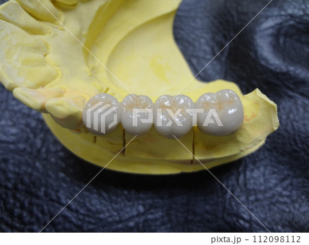 歯科技工のメタルボンド自費模型・きれいに並んだ白い歯 112098112