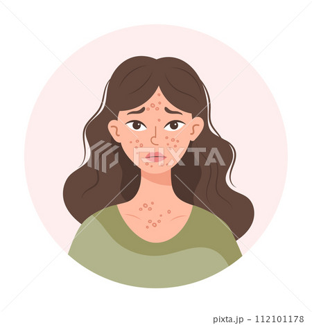 Acne. Unhappy teenage girl with acne and pimples on her face. Irritated facial skin. Illustration, vector 112101178