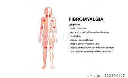 Fibromyalgia medical poster Fibromyalgia medical poster 112104147