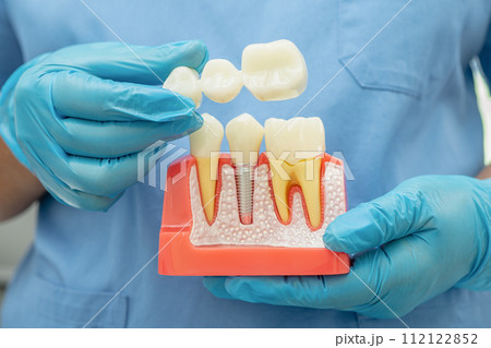 Dental implant, artificial tooth roots into jaw, root canal of dental treatment, gum disease, teeth model for dentist studying about dentistry. 112122852