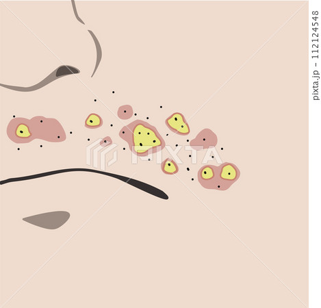 男性の口上の髭にできた毛嚢炎 男性の口上の髭にできた毛嚢炎 112124548