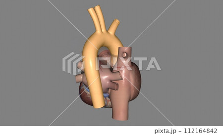 The aorta is the main artery that carries blood away from your heart to the rest of your body 112164842