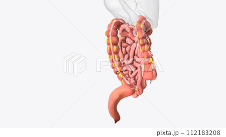 Epiploic appendages are normal outpouchings of peritoneal fat on the anti-mesenteric surface of the colon 112183208