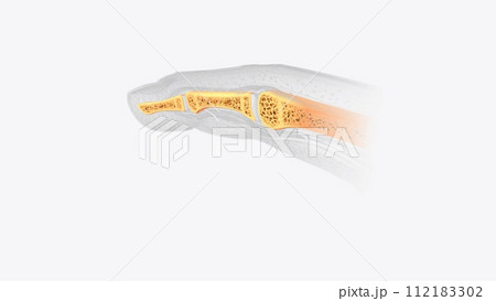 Nail section of bone Nail section of bone 112183302