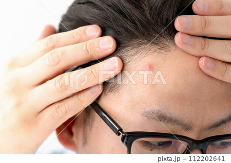 ニキビに悩む男性 ニキビに悩む男性 112202641