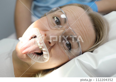 adult woman shows tongue in dental chair in transparent glasses close-up face wrinkles on the forehead surprised look lie on the pillow with optragate mouth expander 112204352