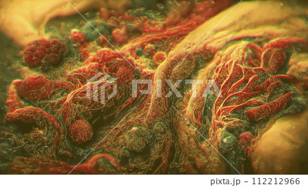 Growth of tumor, illustration Growth of tumor, illustration 112212966