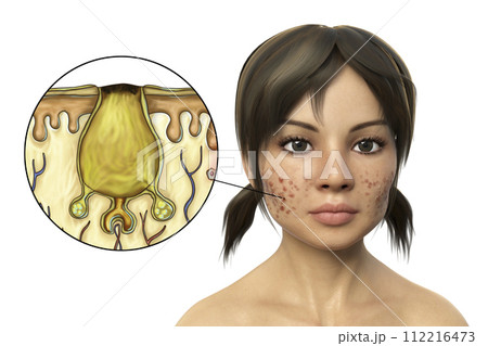 Acne vulgaris, black comedo Acne vulgaris, black comedo 112216473