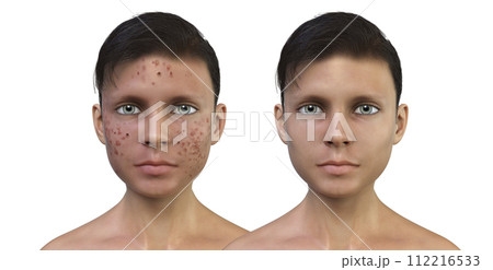 Acne vulgaris in a teenager boy Acne vulgaris in a teenager boy 112216533