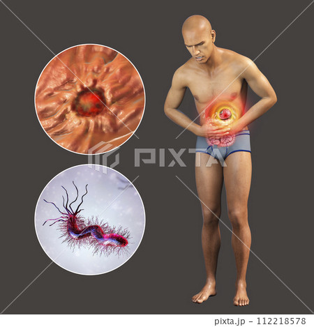 Pain in stomach, gastric ulcer, conceptual 3D illustration 112218578