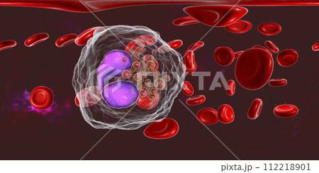 360-degree spherical panorama of blood with eosinophilia 112218901