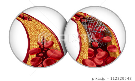 Stents in Angioplasty 112229348