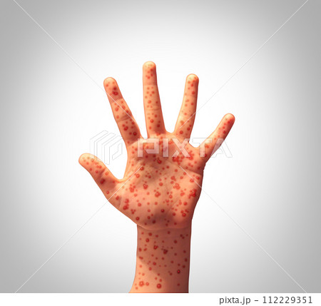 Measles Disease Outbreak Measles Disease Outbreak 112229351