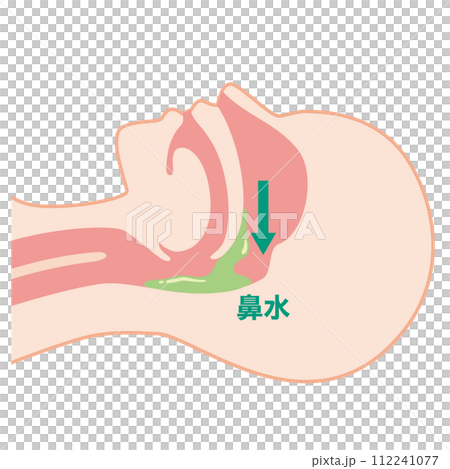 Postnasal drip, supine Postnasal drip, supine 112241077