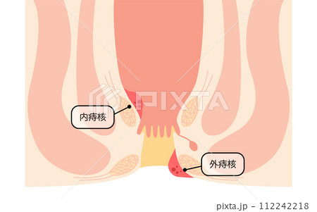 肛門の病気、痔・いぼ痔　図解イラスト、断面図 112242218