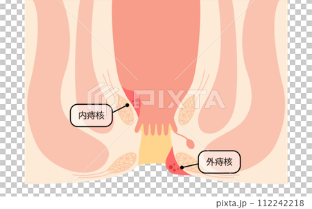 肛門の病気、痔・いぼ痔　図解イラスト、断面図 112242218
