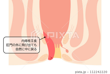 肛門の病気、痔・いぼ痔「内痔核Ⅱ度」　図解イラスト、断面図 112242220