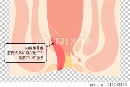 肛門の病気、痔・いぼ痔「内痔核Ⅱ度」　図解イラスト、断面図 112242220