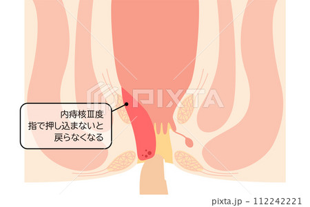 肛門の病気、痔・いぼ痔「内痔核Ⅲ度」　図解イラスト、断面図 112242221