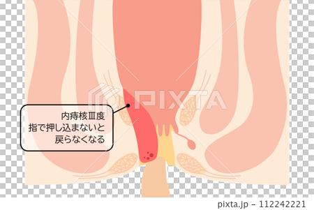 肛門の病気、痔・いぼ痔「内痔核Ⅲ度」　図解イラスト、断面図 112242221
