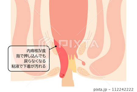 肛門の病気、痔・いぼ痔「内痔核Ⅳ度」 図解イラスト、断面図 肛門の病気、痔・いぼ痔「内痔核Ⅳ度」 図解イラスト、断面図 112242222