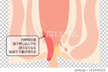 肛門の病気、痔・いぼ痔「内痔核Ⅳ度」 図解イラスト、断面図 肛門の病気、痔・いぼ痔「内痔核Ⅳ度」 図解イラスト、断面図 112242222