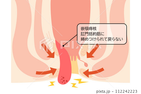 肛門の病気、痔・いぼ痔「嵌頓痔核」 図解イラスト、断面図 肛門の病気、痔・いぼ痔「嵌頓痔核」 図解イラスト、断面図 112242223