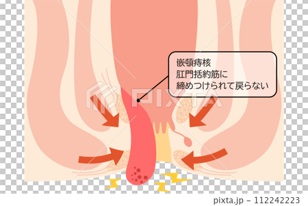 Anal disease, hemorrhoids/wart hemorrhoids "incarcerated hemorrhoids" Illustrated illustrations, cross-sectional views 112242223