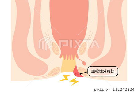 肛門の病気、痔・いぼ痔「血栓性外痔核」　図解イラスト、断面図 112242224