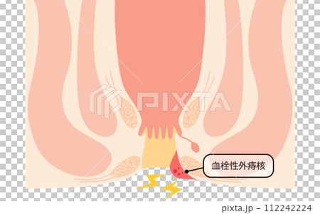 肛門の病気、痔・いぼ痔「血栓性外痔核」　図解イラスト、断面図 112242224