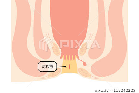 肛門の病気、痔「切れ痔(裂肛)」 図解イラスト、断面図 肛門の病気、痔「切れ痔(裂肛)」 図解イラスト、断面図 112242225