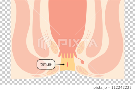 肛門の病気、痔「切れ痔(裂肛)」 図解イラスト、断面図 肛門の病気、痔「切れ痔(裂肛)」 図解イラスト、断面図 112242225
