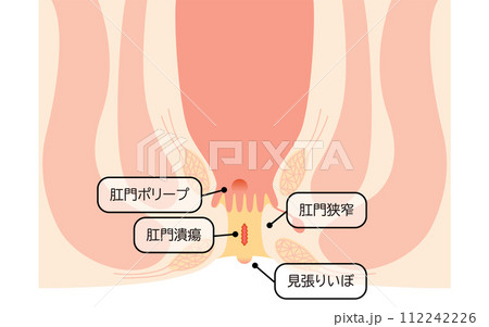 肛門の病気、痔「肛門潰瘍、肛門狭窄、肛門ポリープ」 図解イラスト、断面図 肛門の病気、痔「肛門潰瘍、肛門狭窄、肛門ポリープ」 図解イラスト、断面図 112242226