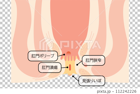 肛門の病気、痔「肛門潰瘍、肛門狭窄、肛門ポリープ」 図解イラスト、断面図 肛門の病気、痔「肛門潰瘍、肛門狭窄、肛門ポリープ」 図解イラスト、断面図 112242226