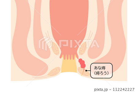 肛門の病気、痔「あな痔（痔ろう）」　図解イラスト、断面図 112242227