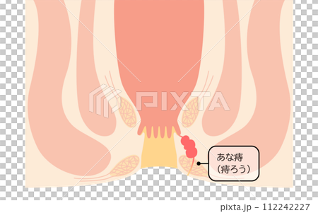 肛門の病気、痔「あな痔（痔ろう）」　図解イラスト、断面図 112242227